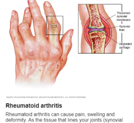 Ρευματοειδής αρθρίτιδα (Rheumatoid arthritis)